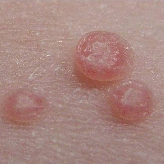 genital skin tags vs warts