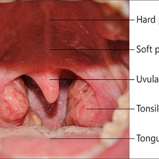 tonsils adult throat Sore