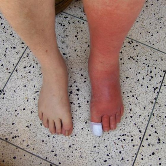 Test for Cellulitis | Healthy Living