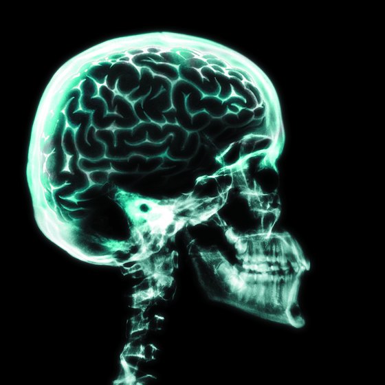 concussion after effects