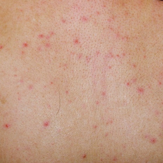Skin Rashes Caused By Viral Infection Healthy Living Dark Brown Hairs