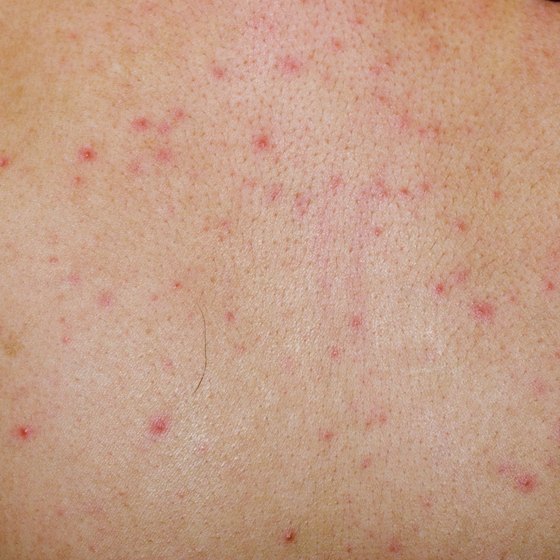 Viral Infection Rash Gue Viral