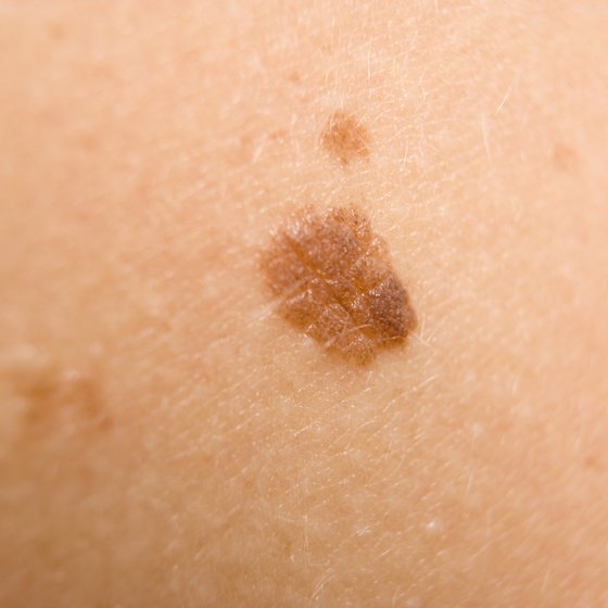 melanoma cancerous skin tags pictures