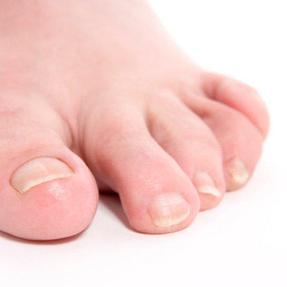 What Do Ridges In Your Toenails Mean