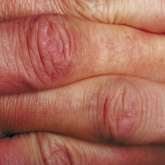 What Are Itchy Swollen Hands A Symptom Of