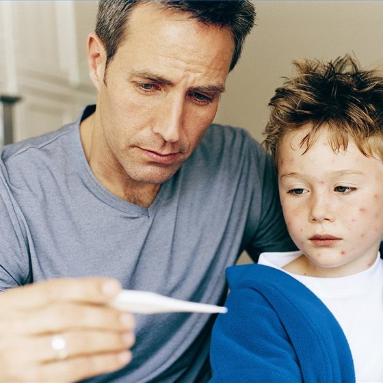 How to Recognize Chicken Pox | Healthy Living