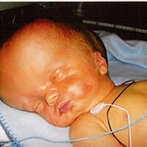 Normal Pressure Hydrocephalus In Child