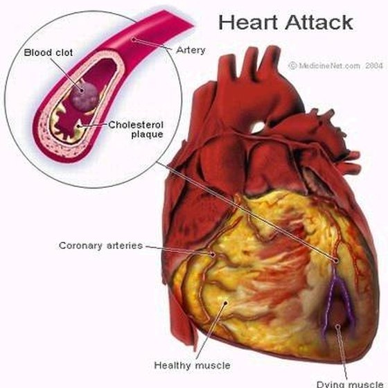 heart-blockage-symptoms-healthy-living