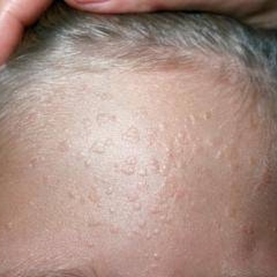 what-causes-warts-on-the-face-healthy-living