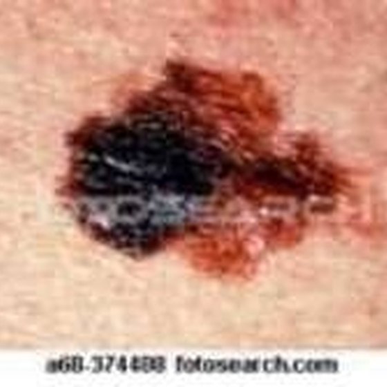 How To Tell If Moles Are Skin Cancer Healthy Living