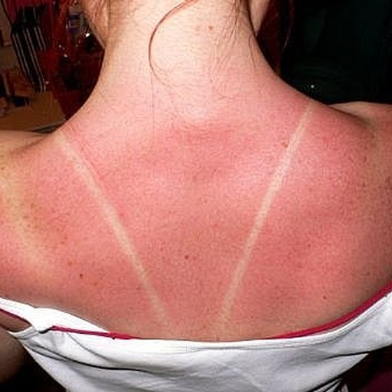 How to Identify and Treat Sun Poisoning Healthy Living