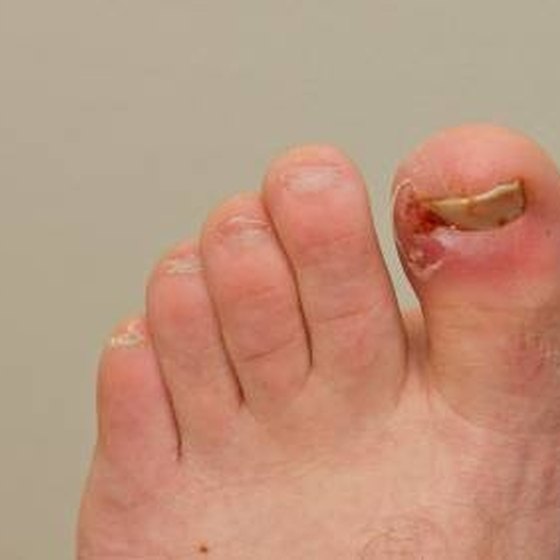 diabetic feet itch