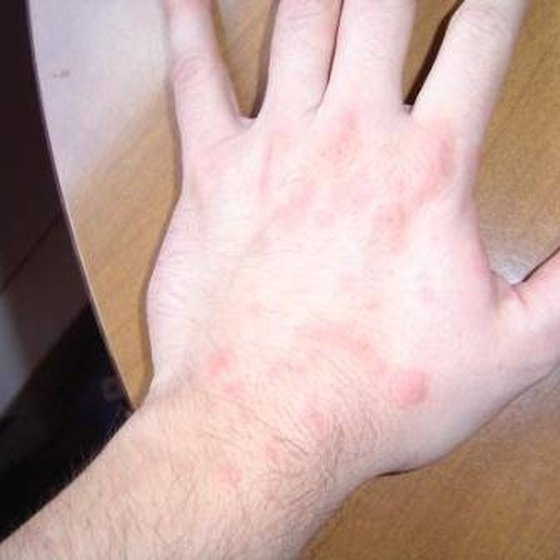 Benadryl allergy syrup hives