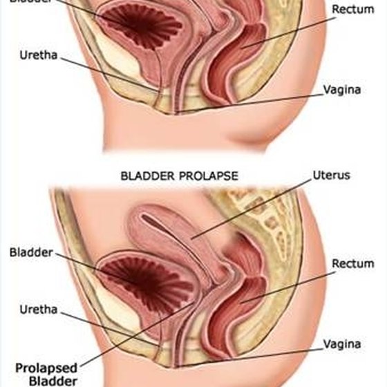 Remedies For A Prolapsed Bladder Healthy Living