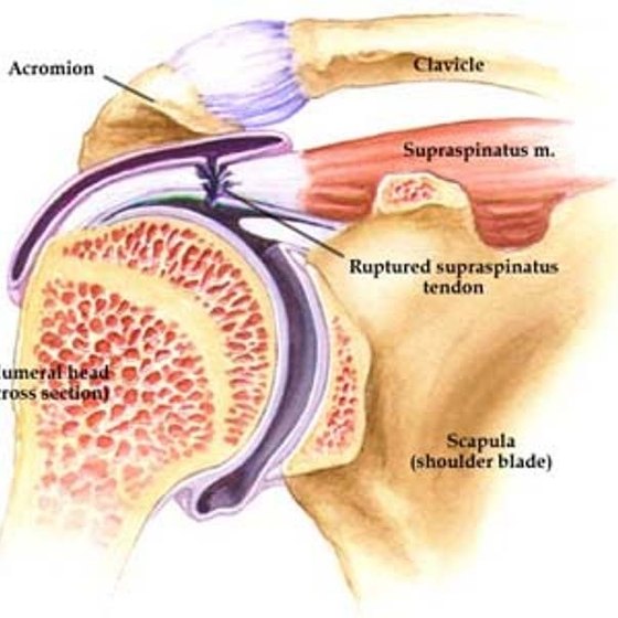 What Is the Supraspinatus Tendon? | Healthy Living