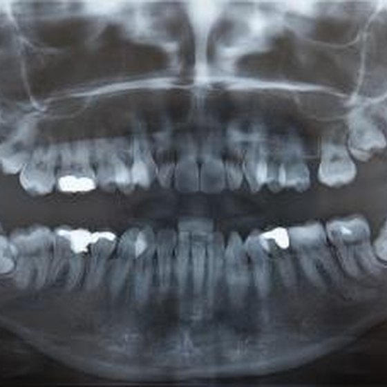 How to know when to use mouthwash after wisdom tooth extraction