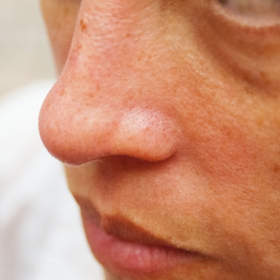 Treatment For Red Skin On Nose Nurse Who Began Using Sunbeds Aged 13