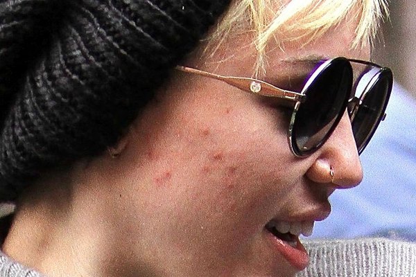 Miley Cyrus fotografiada sin maquillaje y con su rostro afectado por el acné.