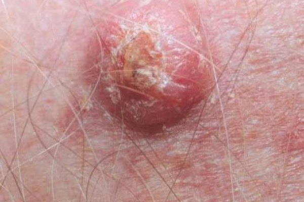 what-causes-warts-on-the-face-healthy-living