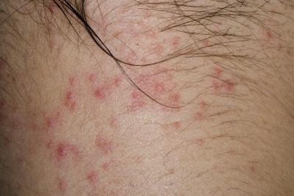 How To Heal Bed Bug Bites Healthy Living