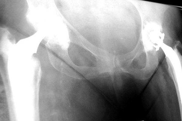 Las prótesis de cadera de titanio son compatibles con la IRM.