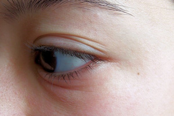 La hinchazón facial suele ocurrir al rededor de los ojos.