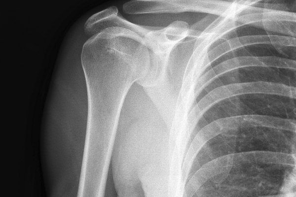 xray pinched nerve in neck
