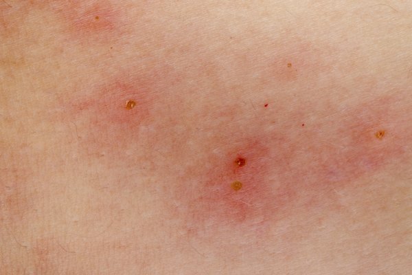 swimmers itch rash