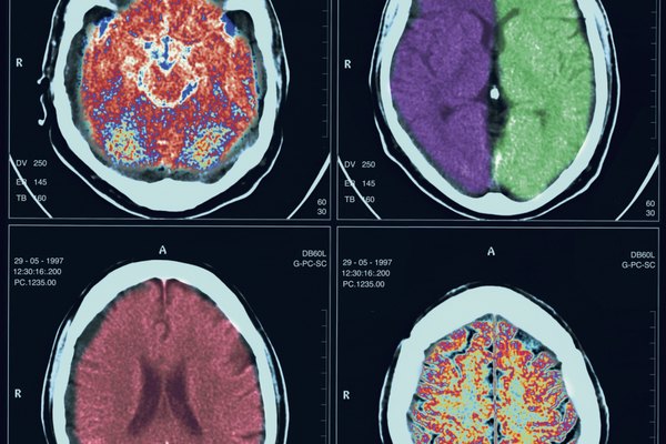 What Is Tuberculosis of the Brain? | Healthy Living