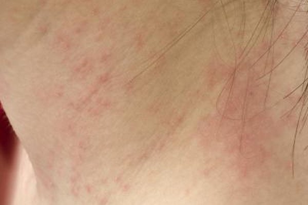 What Does Skin Shingles Look Like? | Healthy Living