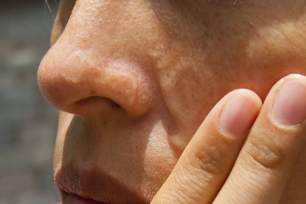 How to Get Rid of Red on the Side of the Nose | Healthy Living