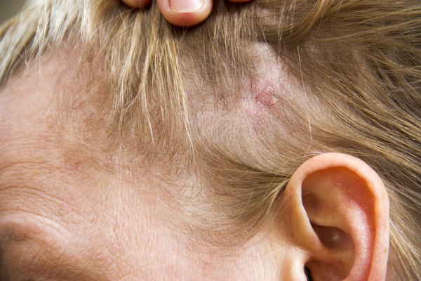 Cures for Scalp Fungus