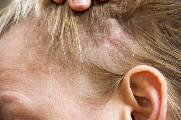 scalp fungus infection head ringworm cures causes tinea conditions treat