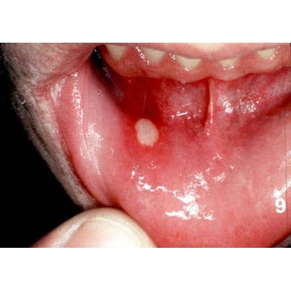 mouth-ulcer-remedy-healthfully