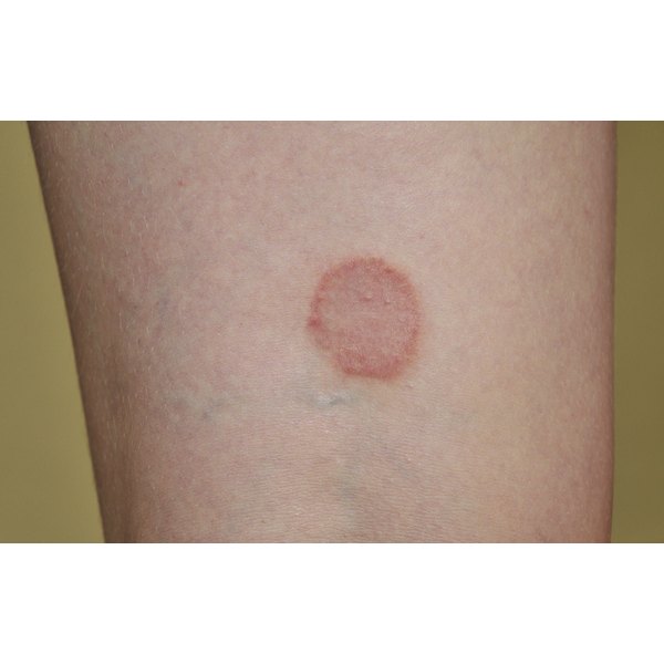 what-happens-if-ringworm-is-untreated-healthfully