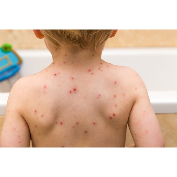Diseases That Cause Blisters In Children Healthfully