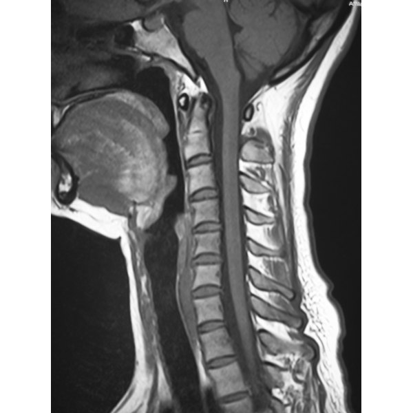 Cervical Transverse Process Fracture