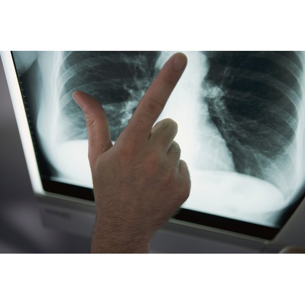 The Dangers of Tuberculosis | Healthfully