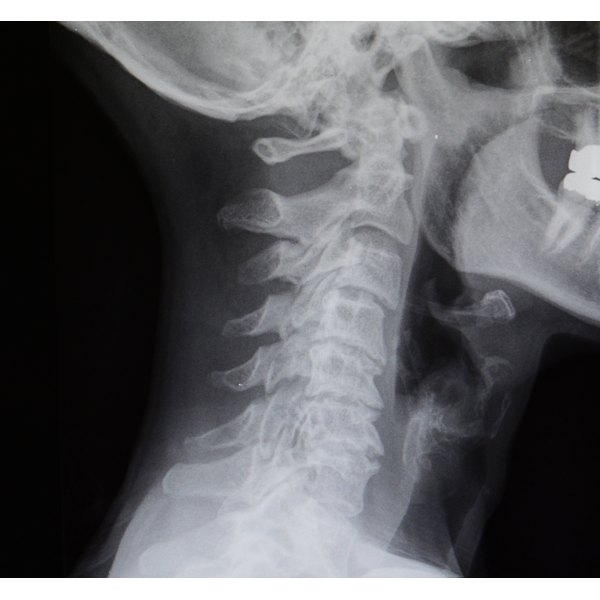 2 puncture wounds at base of neck where brain and spinal cord was sucked out