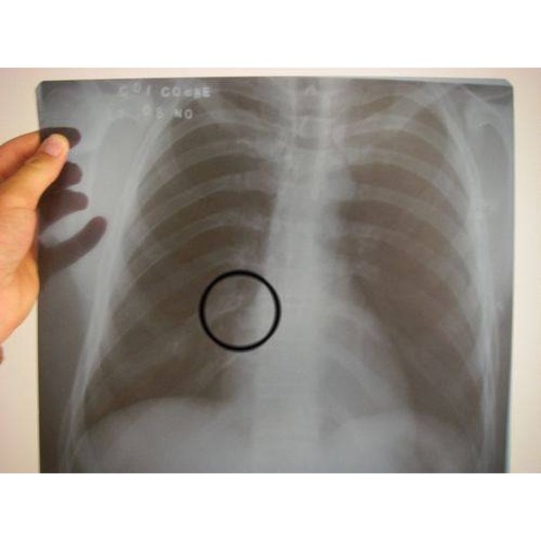 Припухлость ребра слева. Перелом ребра снимок рентген. Перелом 12 ребра рентген. Рентген перелом ребра слева.