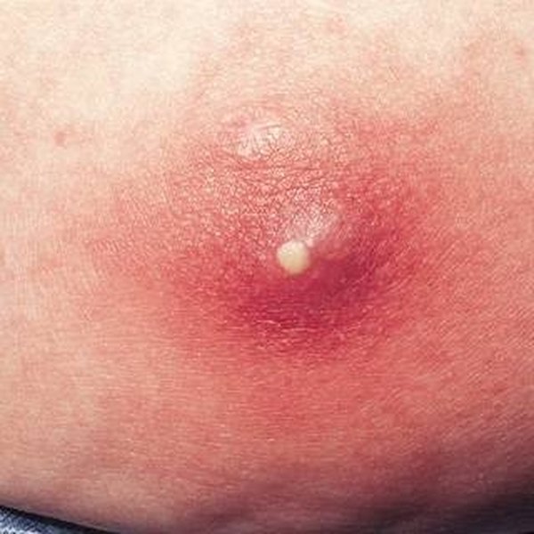 painful boils