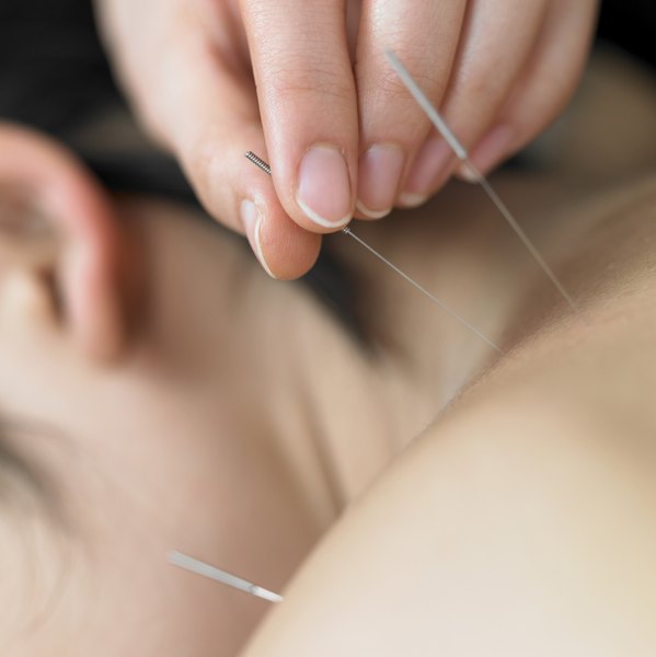 A acupuntura ajuda a combater a ansiedade, proporcionando uma boa noite de sono