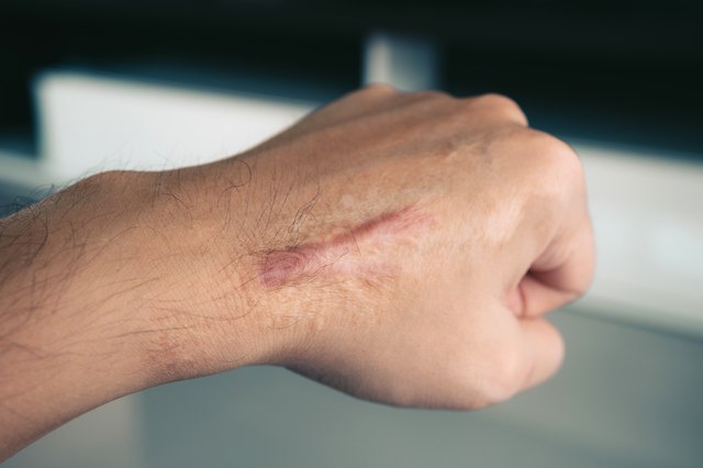 Cropped Image Of Scar