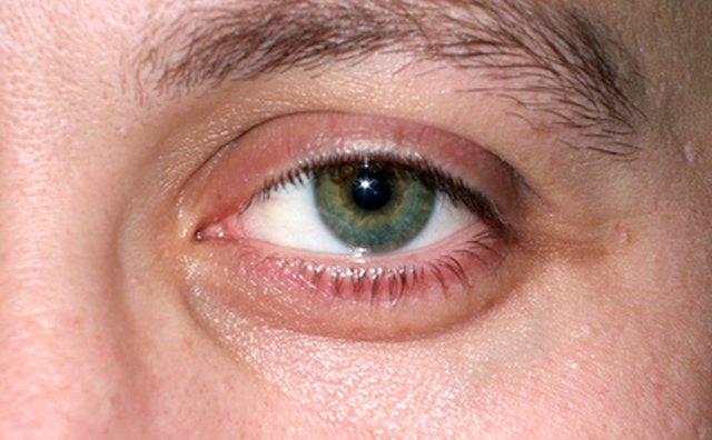 Strained eye