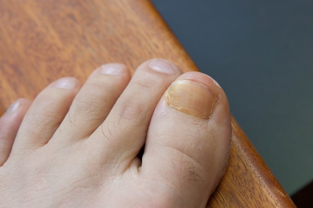 how-to-get-rid-of-brown-toenails-leaftv