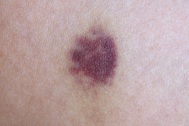 What Causes Blue Black Marks On Body