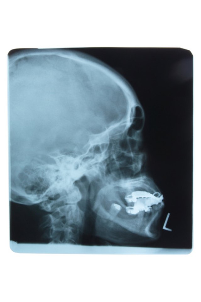 Exercises to Stretch the Lateral Pterygoid Muscles