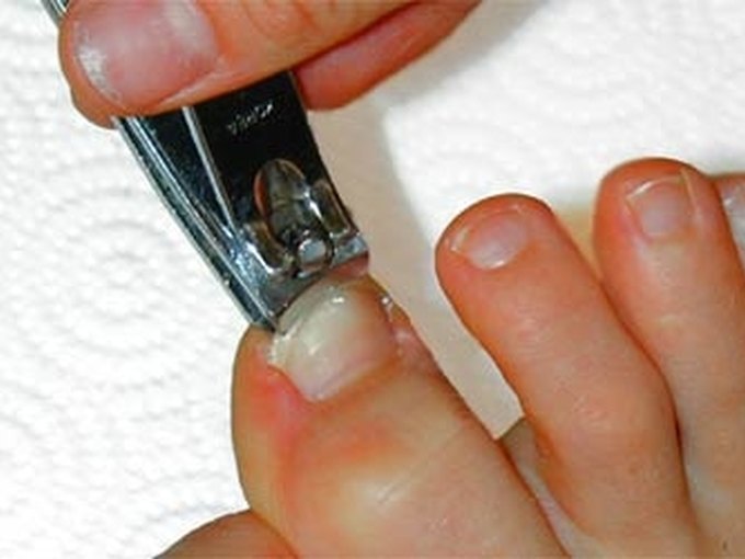 How to Treat Thick, Discolored Toenails LEAFtv