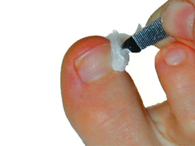 How to Treat Thick, Discolored Toenails LEAFtv