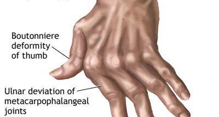 Arthritic Hands, New York Times